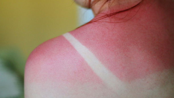 opekotine od sunca simptomi